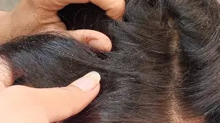 No More Lice in Just 1 Day! | 100% Effective Lice Treatment#LiceRemoval #NaturalRemedy #HairCare