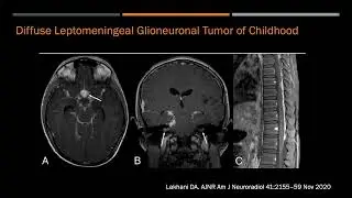 Acute encephalopathy