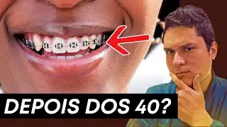 Aparelho Ortodôntico DEPOIS dos 40 é possível? A VERDADE que POUCOS falam…