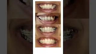 Before and after braces🥰 #braces #ceramic Adult braces Journey Orthodontic Treatment