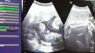 ULTRASOUND MY BABY IKKI 35 WEEKS
