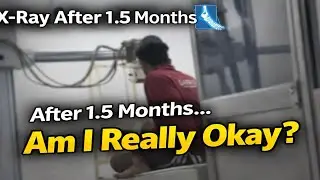 After 1.5 Months&hellip; X-Ray Report 😥 | Am I Really Okay or Not ? | Himanshu Pal Vlogs 