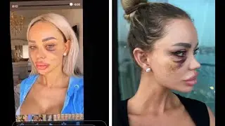Povestea pozelor &icirc;n care Bianca Drăgușanu apare desfigurată