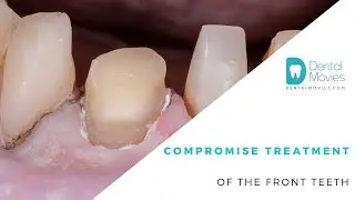 Compromise treatment of the front teeth
