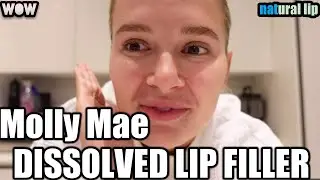 Molly Mae I Had my Lip Filler Completely Dissolved/Love Island star Molly Mae