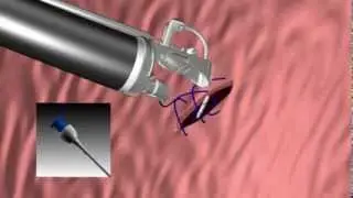 OverStitch&trade; Animation - Suturing Sequence
