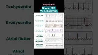 Normal ECG vs Arrhythmias