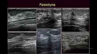 The implication of understanding Sonographic anatomy in interpreting Breast ultrasound(2)