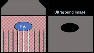 Posterior acoustic enhancement