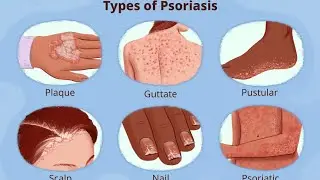 🔥 Psoriasis Skin Problem | Itching & Pain Relief 🔥 #Psoriasis #SkinProblem #ItchingRelief #modicare 