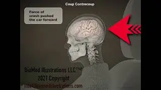 Coup Contrecoup Whiplash Brain Injury
