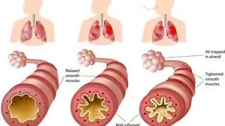 Awareness on Asthma by Sibia Medical Centre