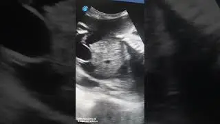 #baby #ultrasound #babyultrasound #pregnant #pregnancyscan #pregnancyjourney #babyscan #bebe