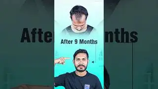 Hair Transplant in Bangladesh | Cost & Results (9 Months) #hairtransplant #bangladesh #shorts