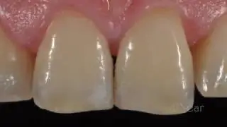 Resin Infiltration Treatment