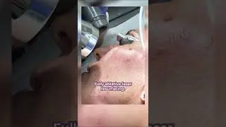 Fractional vs Ablative Laser Resurfacing ⚡️🔅