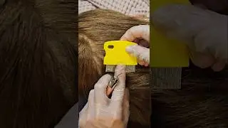 ASMR Found lice during scalp inspection