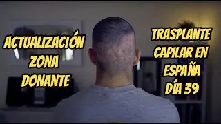 Trasplante de pelo en España, Día 39