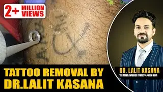TATTOO REMOVAL by Dr.Lalit Kasana (IN HINDI)