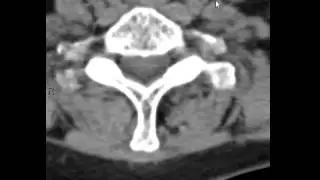 Reading a C spine CT for trauma