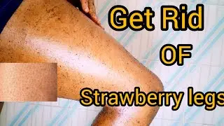 How i  get Rid of Strawberry legs /Chicken skin at Home.