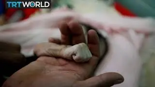 The War In Yemen: UN says 12 to 14M people are starving