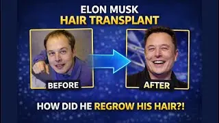 Elon Musk Hair Transplant: Did He Really Regain His Hair? Before and After Analysis