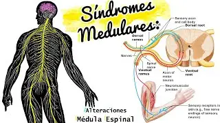 SÍNDROMES MEDULARES repaso y CASO CLÍNICO