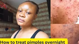 How to get rid of pimples naturally | How I cleared my Acne using simple Effective home made Recipe
