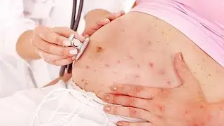 علاج الجدري ومشاكله و الحامل لو اتعرضت للعدوي تاخد علاج ولا خطر عليها ❓