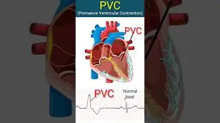 Heart with PVCs l #heart #ecg #shorts
