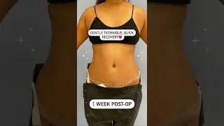 Tummy Tuck Recovery Timeline
