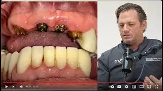 The True Cost of Dental Implants: Expertise Matters