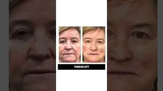 Quick Facelift with Aptos Threads by Dr Rajesh Vasu