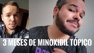 🔴 3 Meses de Minoxidil da Manual na Barba. Funciona?