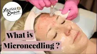 Microneedling: What Is It And Does It Work? | Lipstick Empire