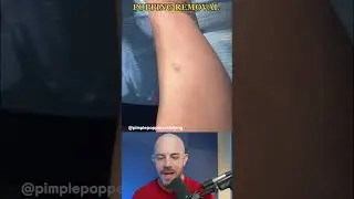 Super laser cyst pop💥 #cystpop #dermreacts #doctorreacts #pimplepop