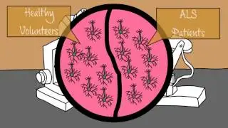 The Role of RNA Binding Protein hnRNP A2/B1 in ALS