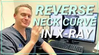 Reverse Neck Curve: Causes, Effects, and Solutions | Spine & Injury Medical Center | San Jose, CA