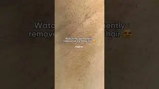 12 months of using Lumi IPL Hair removal  #hairremoval #laserhairremoval #hairremovalmethods