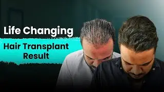 Hair Transplant in Guwahati | DHI India | 12,409 Follicles, Natural High-Density Results