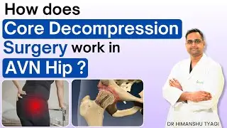 : How does Core Decompression surgery work in AVN Hip ? | Stage 1 & 2 Treatment Explained
