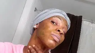 Using Jamaican Cerasee for my acne