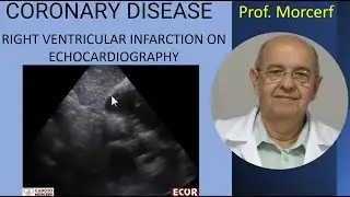 RIGHT VENTRICULAR INFARCTION ECHOCARDIOGRAM