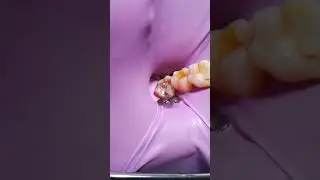 Isolation 48-44 tooth.#cofferdamrubber #раббердамология 