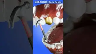 🔴Tener Dientes de Oro Puede Ser Doloroso😱🌀Fandub Español🌀 [ Zeck Felms en Español ] #memes #fandub