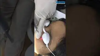 CO2 Laser Mole Removal