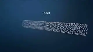 #keşfet #KalpBilimi | #anjiyoplasti (#stent) işlemi | #angioplasty (stent) procedure