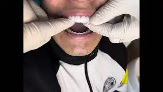 Performing Snap-on Smile laminate