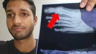 X-ray Karwa hi liya Vlog (Growth Plates: Open or Closed?)